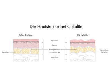 Verschiedene Hautschichten im Vergleich ohne Cellulite und mit Cellulite