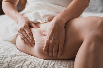 Frau im Sitzen drückt ihre Haut am Oberschenkel so zusammen, dass Cellulite entsteht