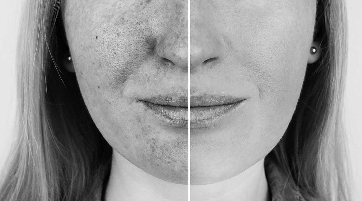 Auswirkung von UV(A) Strahlen auf die Haut im direkten Vergleich nebeneinander. Links UV-geschädigte Haut und rechts UV-geschützte Haut