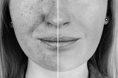 Auswirkung von UV(A) Strahlen auf die Haut im direkten Vergleich nebeneinander. Links UV-geschädigte Haut und rechts UV-geschützte Haut