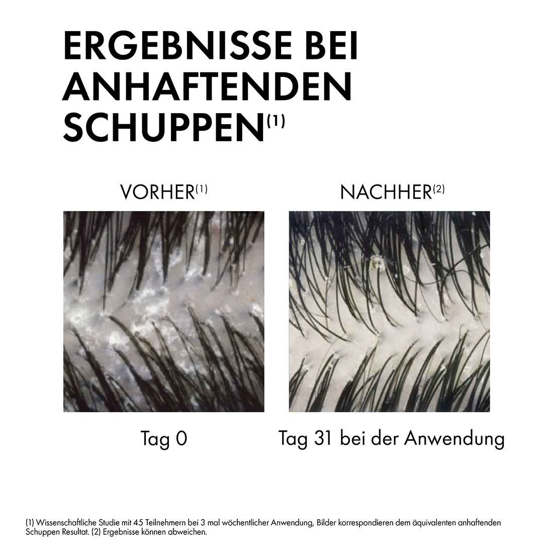 In einer Nahaufnahme der Kopfhaut werden die Ergebnisse des Shampoos bei anhaftenden Schuppen gezeigt. Nach 31 Tagen der Anwendung ist die Kopfhaut im Vergleich zu vorher von anhaftenden Schuppen befreit (Wissenschaftliche Studie mit 45 Teilnehmern bei 3 mal wöchentlicher Anwendung. Bilder korrespondieren dem äquivalenten anhaftenden Schuppen Resultat. Ergebnisse können abweichen).