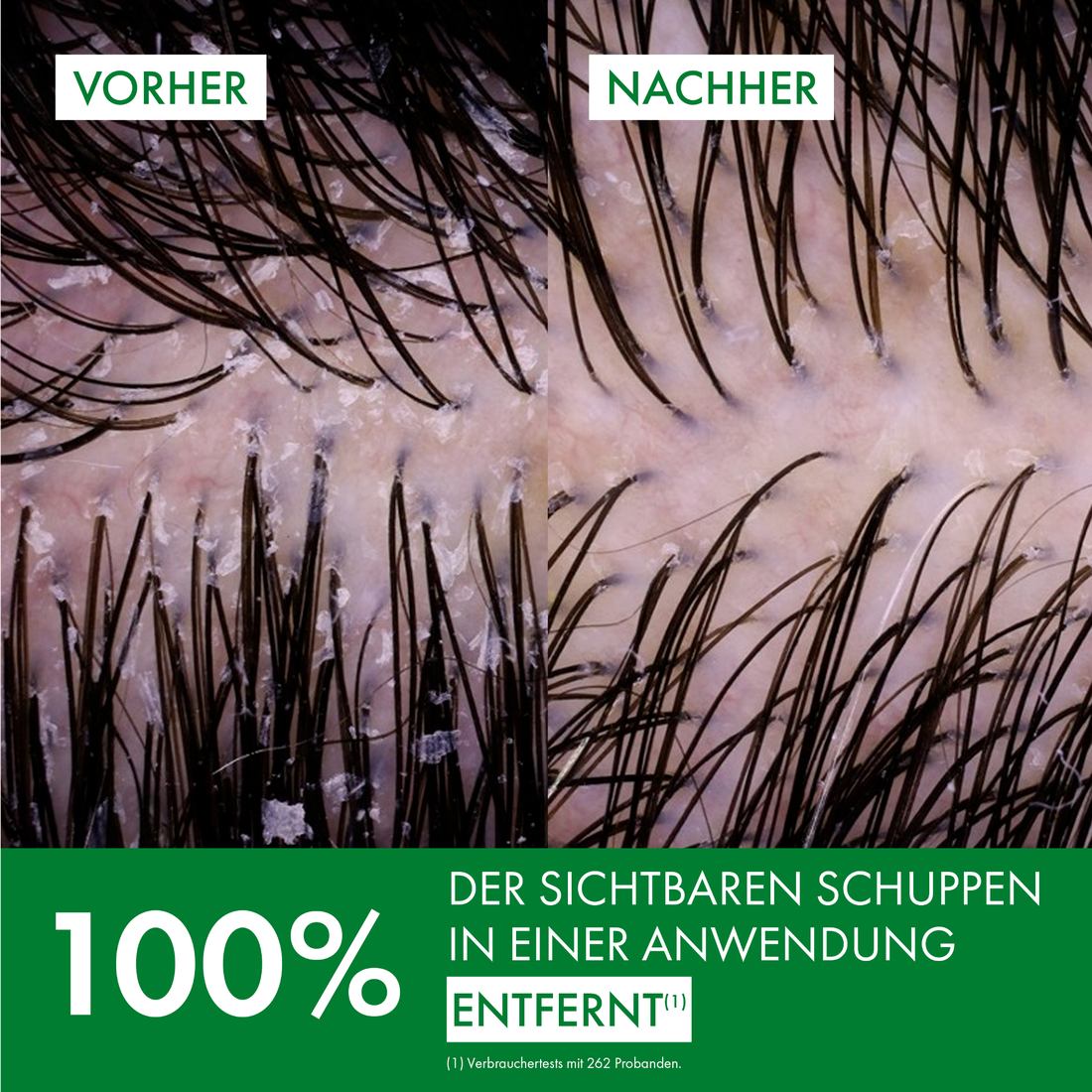 Vorher-Nachher-Vergleich der Kopfhaut: sichtbare Schuppen werden nach einer Anwendung zu 100 % entfernt.