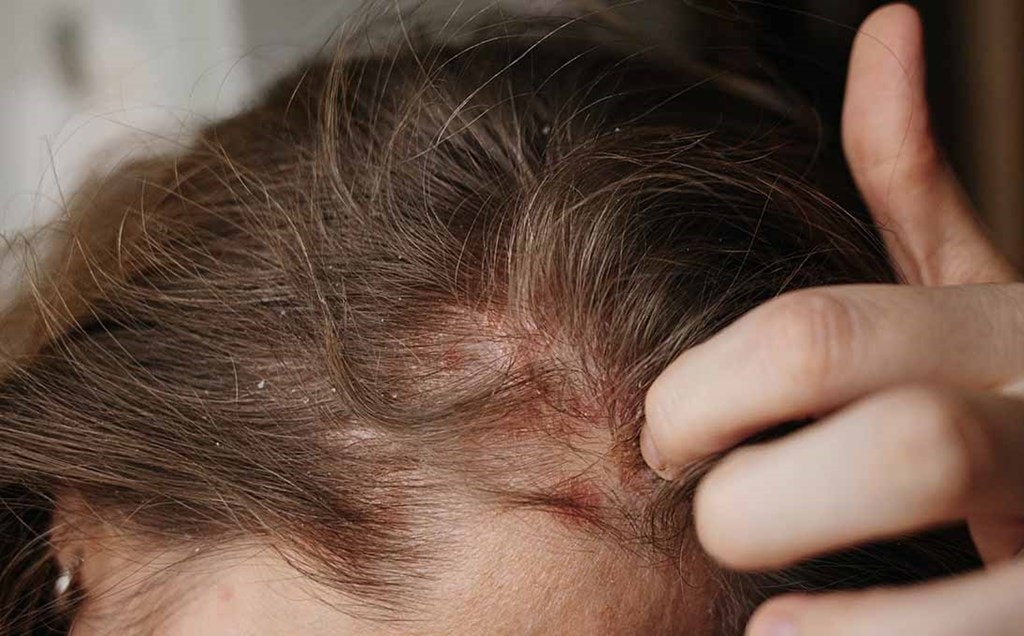 Warum Tut Die Kopfhaut Weh Wenn Die Haare Fettig Sind Juckende Kopfhaut