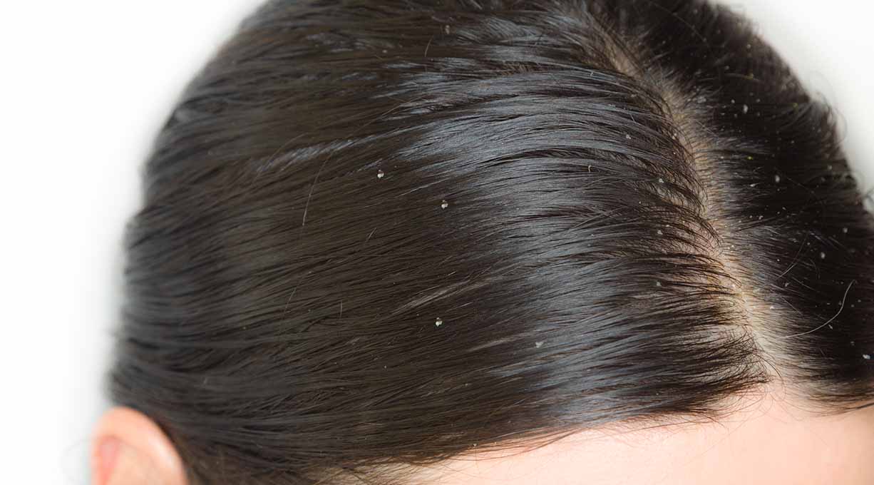 trockene-oder-fettige-schuppen
