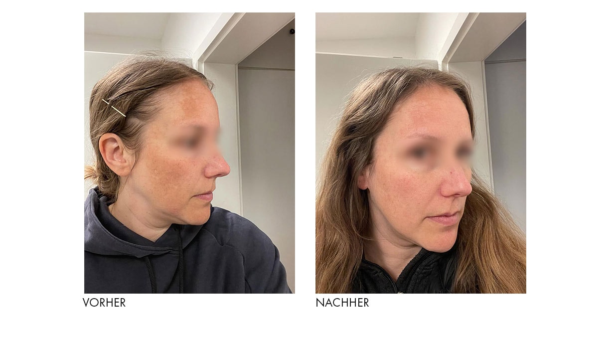 LIFTACTIV B3 Anti-Pigmentflecken LSF 50 Creme | VICHY LIFTACTIV B3 Anti-Pigmentflecken LSF 50 Creme | VICHY